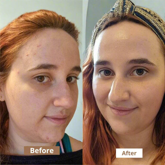 Before and after using August+Monroe Blemish Camouflage on acne