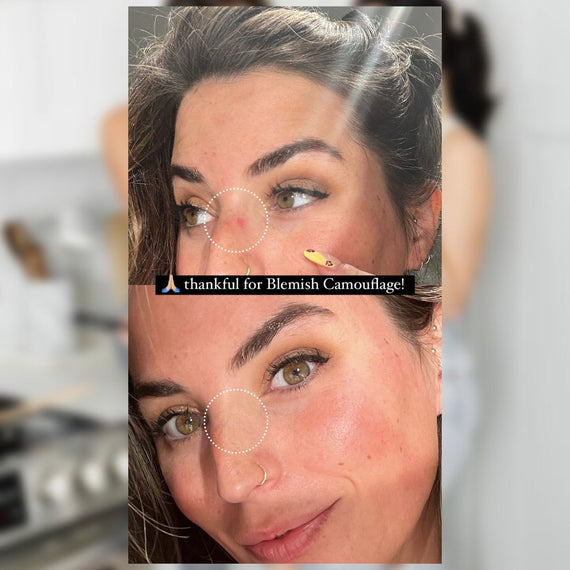 Blemish Camouflage stick concealing a pimple on cheek – clean vegan skincare